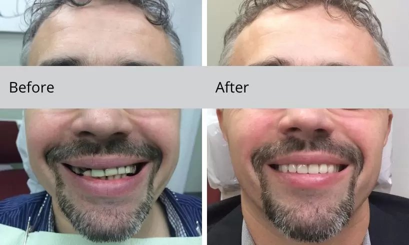before and after