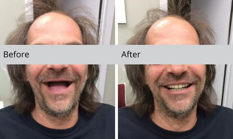 before and after