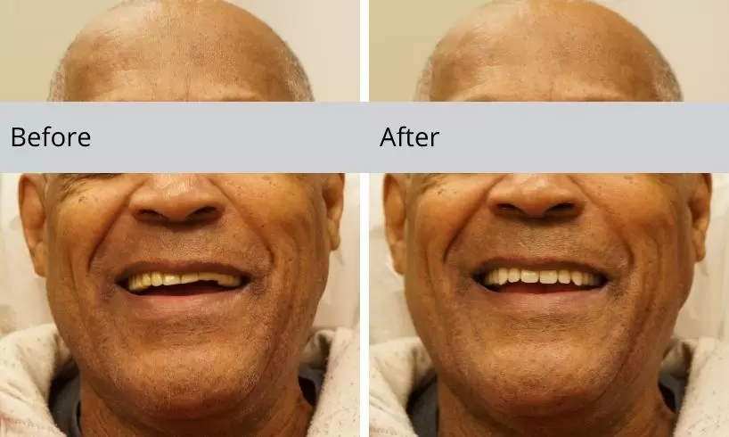 before and after