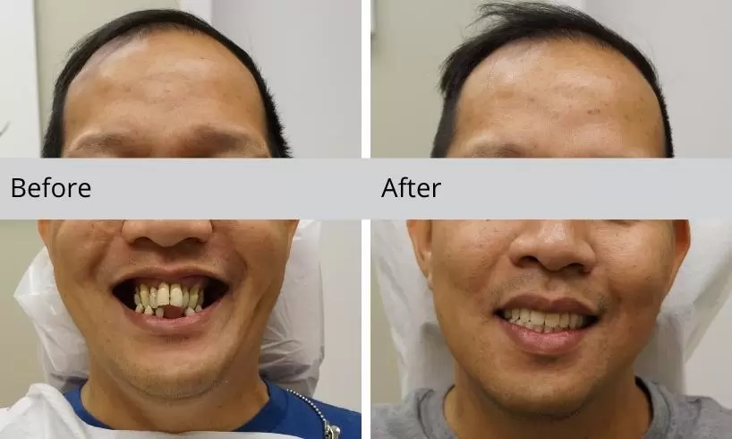 before and after